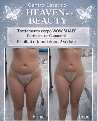 Prima e dopo trattamento corpo WOW Shape dopo 2 sedute